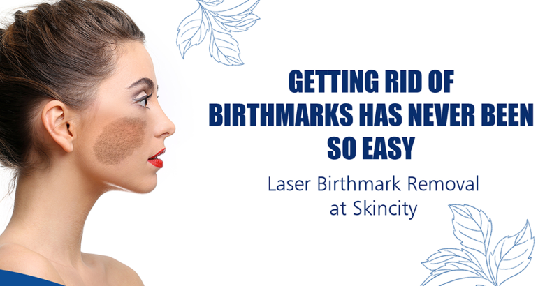 Laser Birth Mark Removal