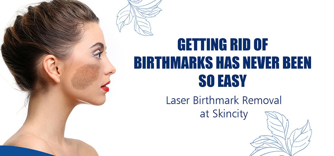 Laser Birth Mark Removal