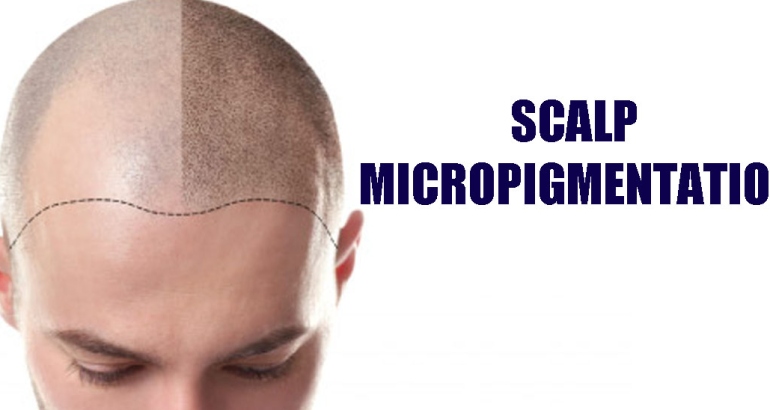 Scalp Micro Pigmentation