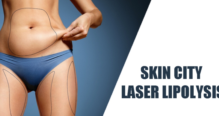 Skin City Laser Lipolysis