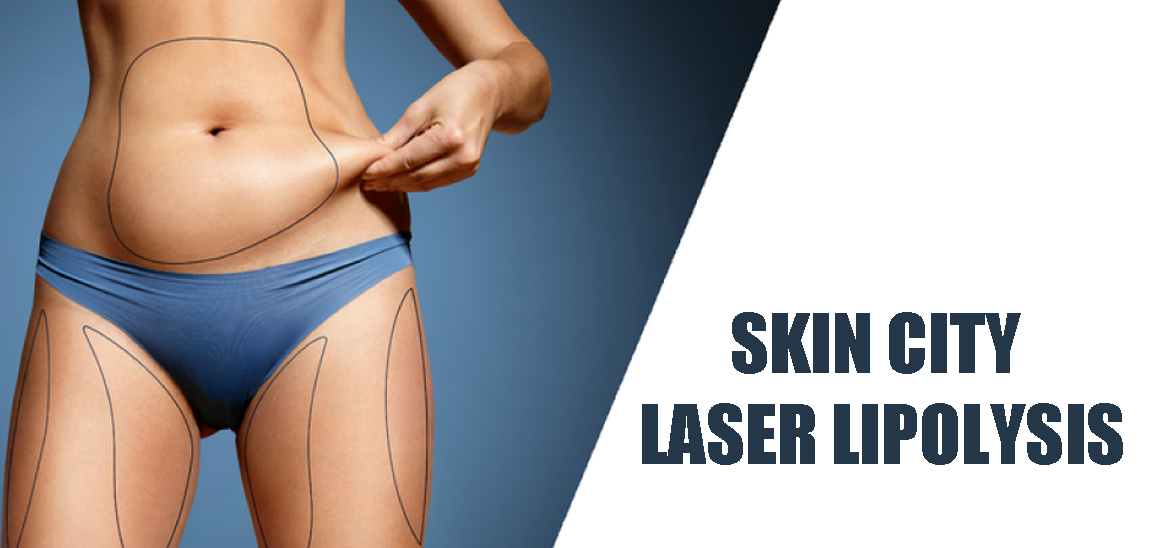 Skin City Laser Lipolysis