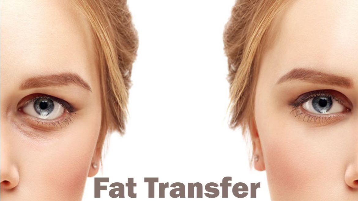 Fat Transfer