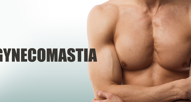 Gynecomastia