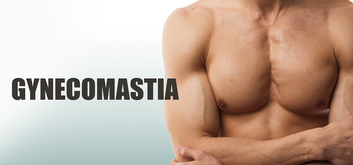 Gynecomastia