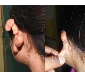 KELOID 1