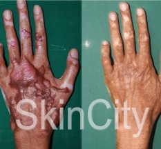 KELOID 2228X1632 KELOID 2228X1632