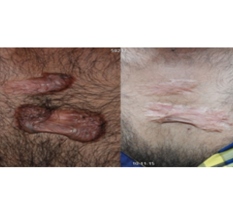 Keloid-Chest Keloid-Chest