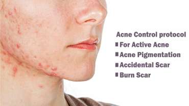 Acne Control Protocol