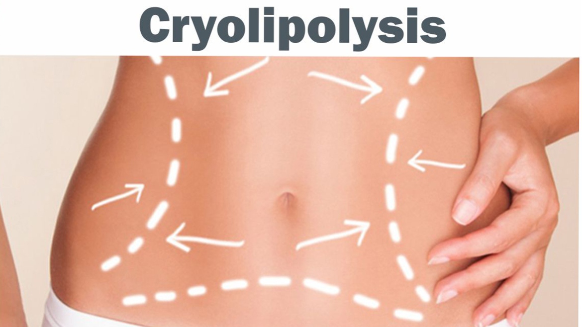 Cryolipolysis