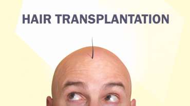 Hair Transplantation