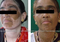 VITILIGO 1