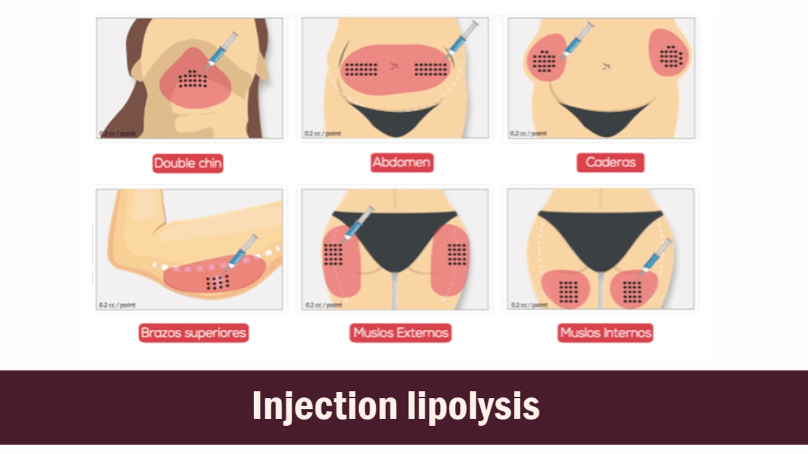 Injection lipolysis