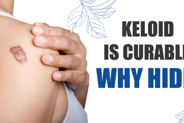 Keloid Clinic