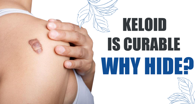 Keloid Clinic