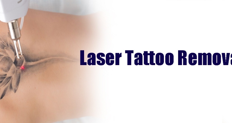 Laser Tattoo Removal