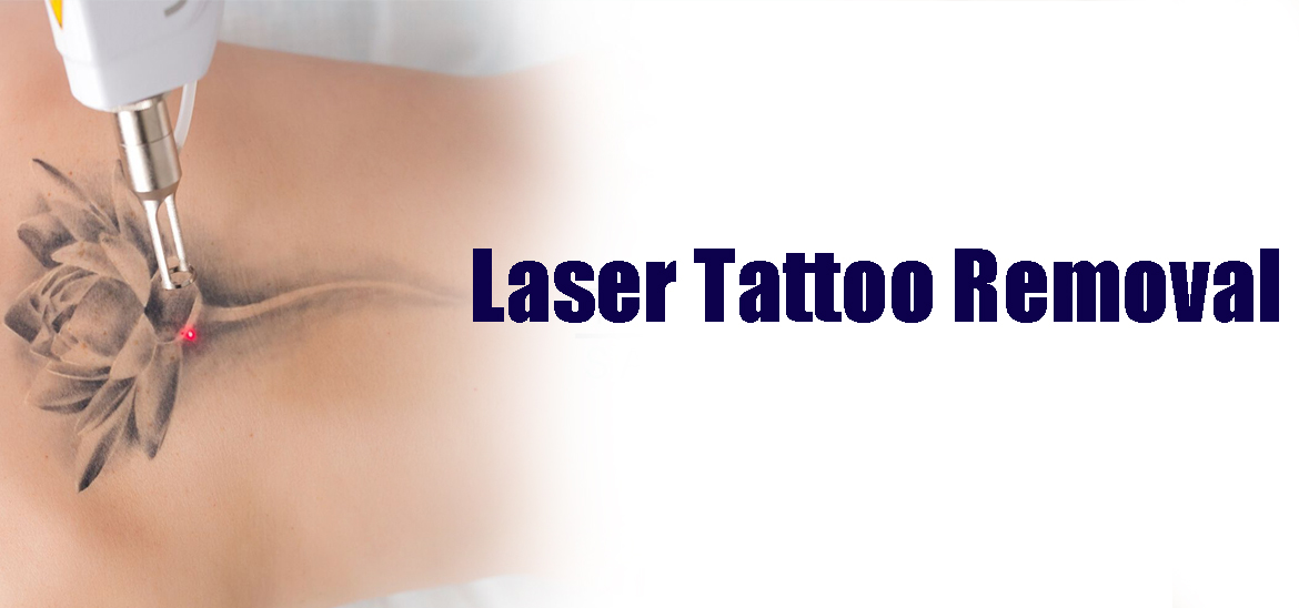 Laser Tattoo Removal