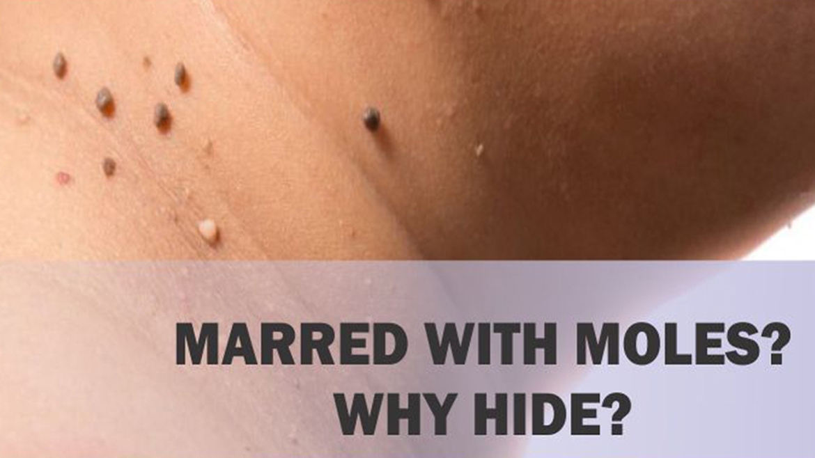 Moles And Skin Tag Removal