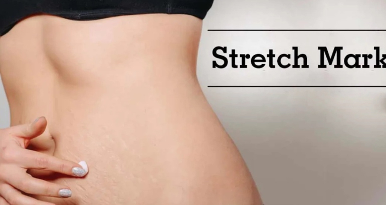 Stretch Mark Removal