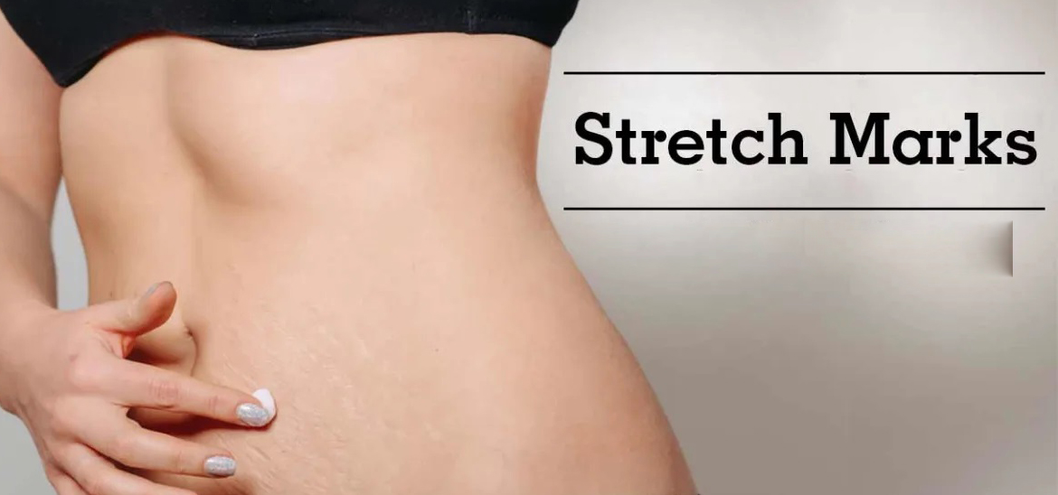 Stretch Mark Removal