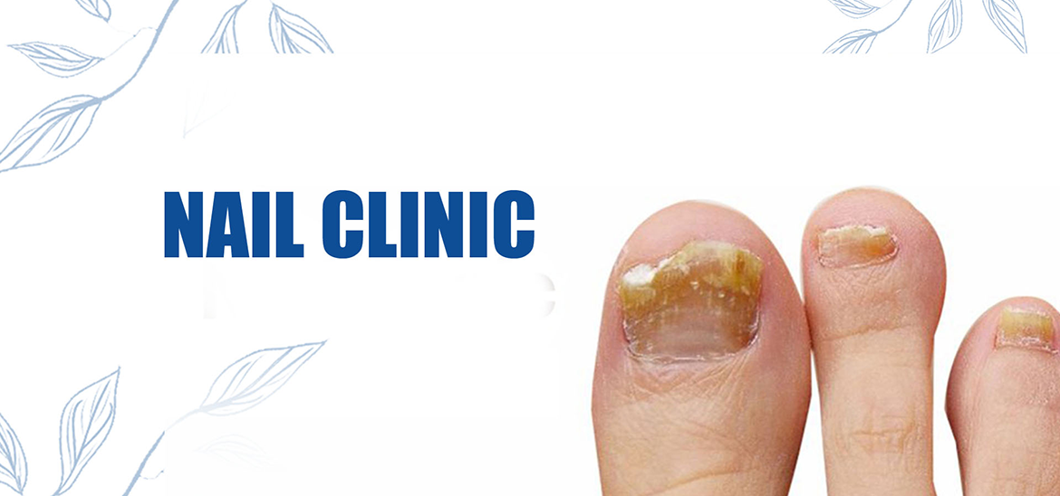 Laser Nail Fungus Treatment | Aria Lase