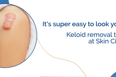 Keloid Clinic