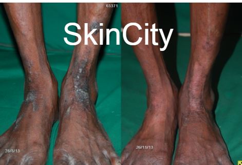 Eczema1