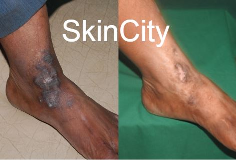 Eczema2