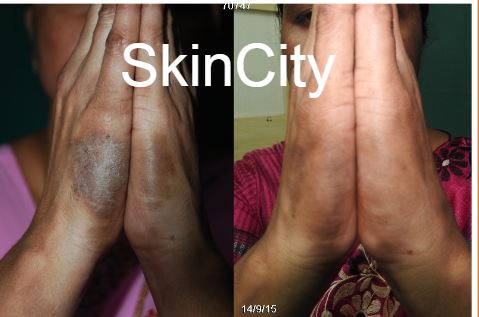 Eczema3