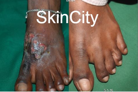 Eczema4