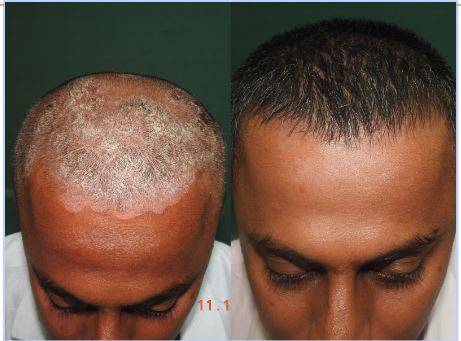Psoriasis1