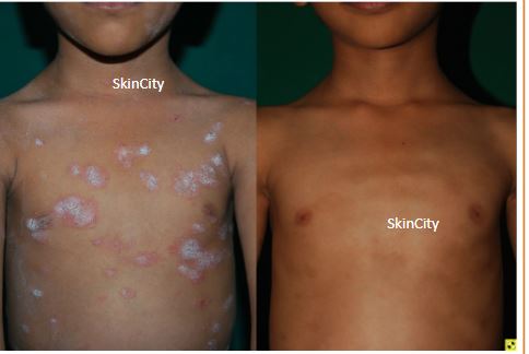 Psoriasis2