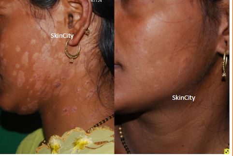 Psoriasis3