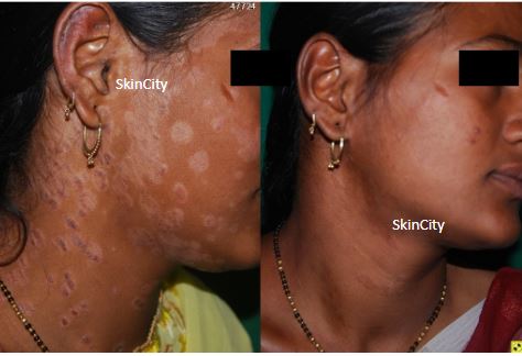 Psoriasis4