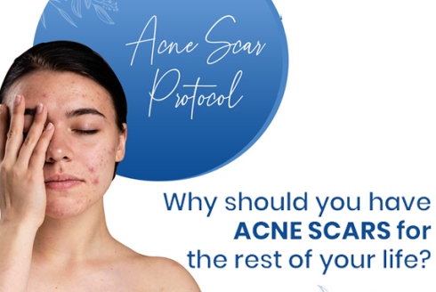 acne scar