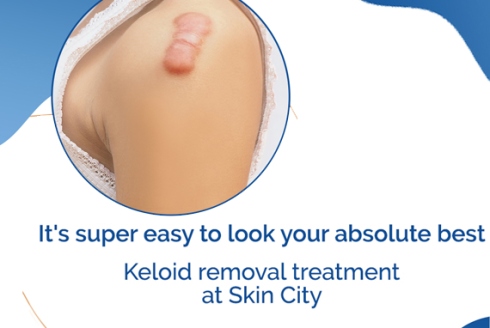 kiloid kiloid
