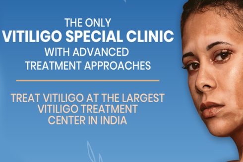 vitiligo vitiligo